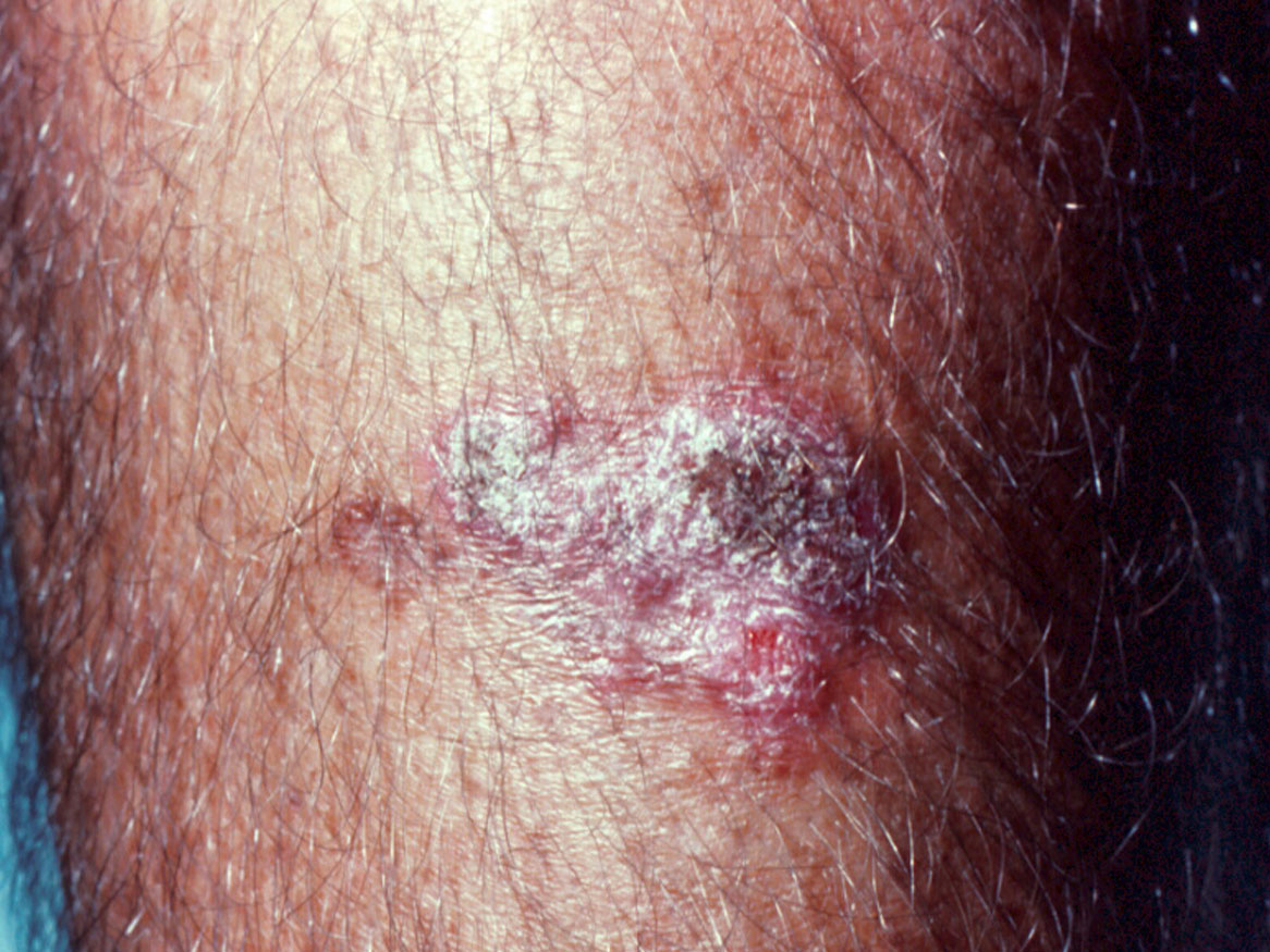 Mcglonic Rash Unknown 33 | Mycology | Adelaide University