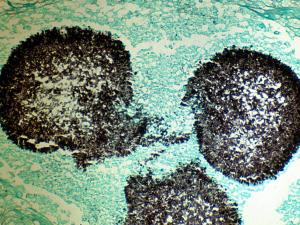 Lung tissue showing fungus balls of hyphae of A. fumigatus. 
