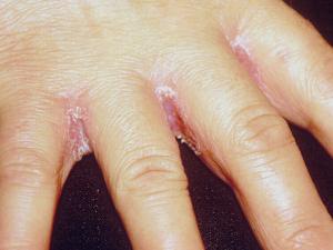 Interdigital candidiasis.