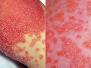 Cutaneous candidiasis. Note: typical satellite lesions present.