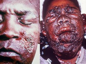 Chronic cutaneous coccidioidomycosis showing granulomatous lesions of the face, neck and chin (Courtesy of John Rippon, USA).