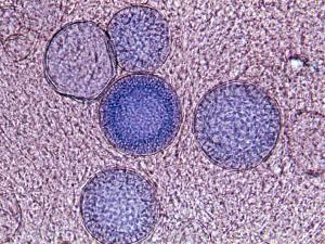 Direct microscopy of skin scrapings from a cutaneous lesion mounted in 10% KOH and Parker ink solution showing characteristic endosporulating spherules (sporangia) of Coccidioides immitis. The presence of spherules with endospores is diagnostic.