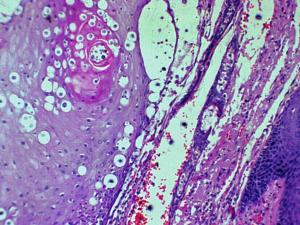 Tissue sections showing from a skin biopsy showing typical yeast cells of C. neoformans.