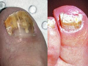 Tinea of the toe nails caused by T. rubrum.