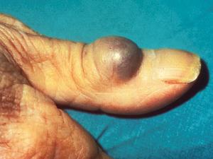 Cutaneous phaeohyphomycosis.