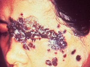 Cutaneous phaeohyphomycosis.