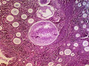 Spherules of rhinosporidiosis.