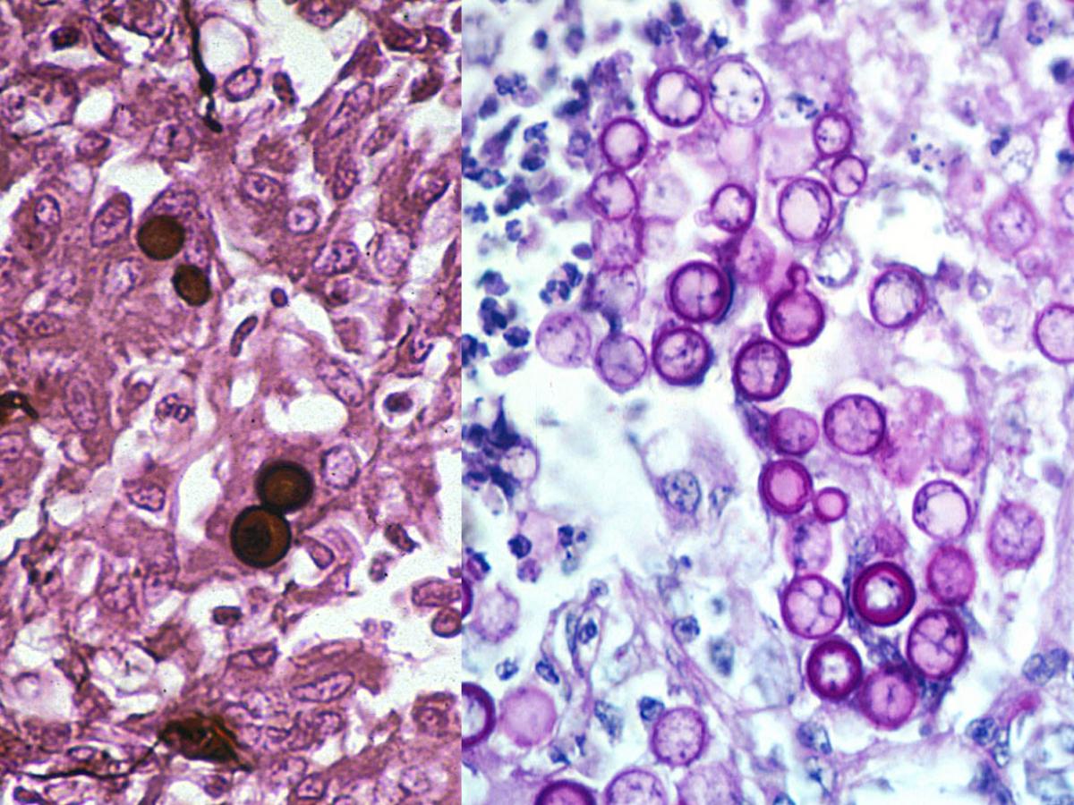 Blastomycosis microscopy