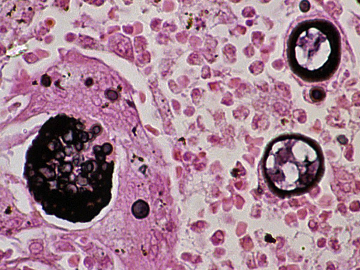 Coccidioides histology