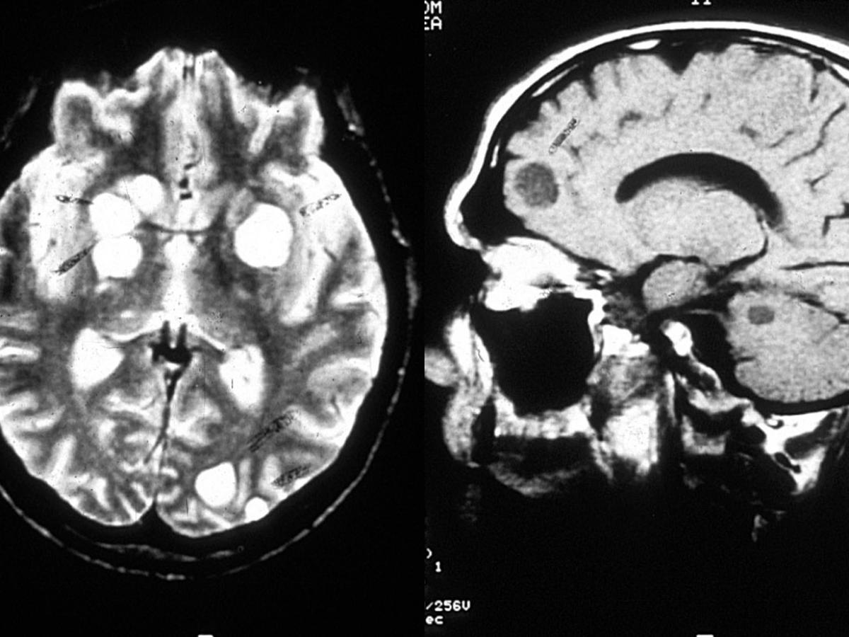 MRI cryptococcosis