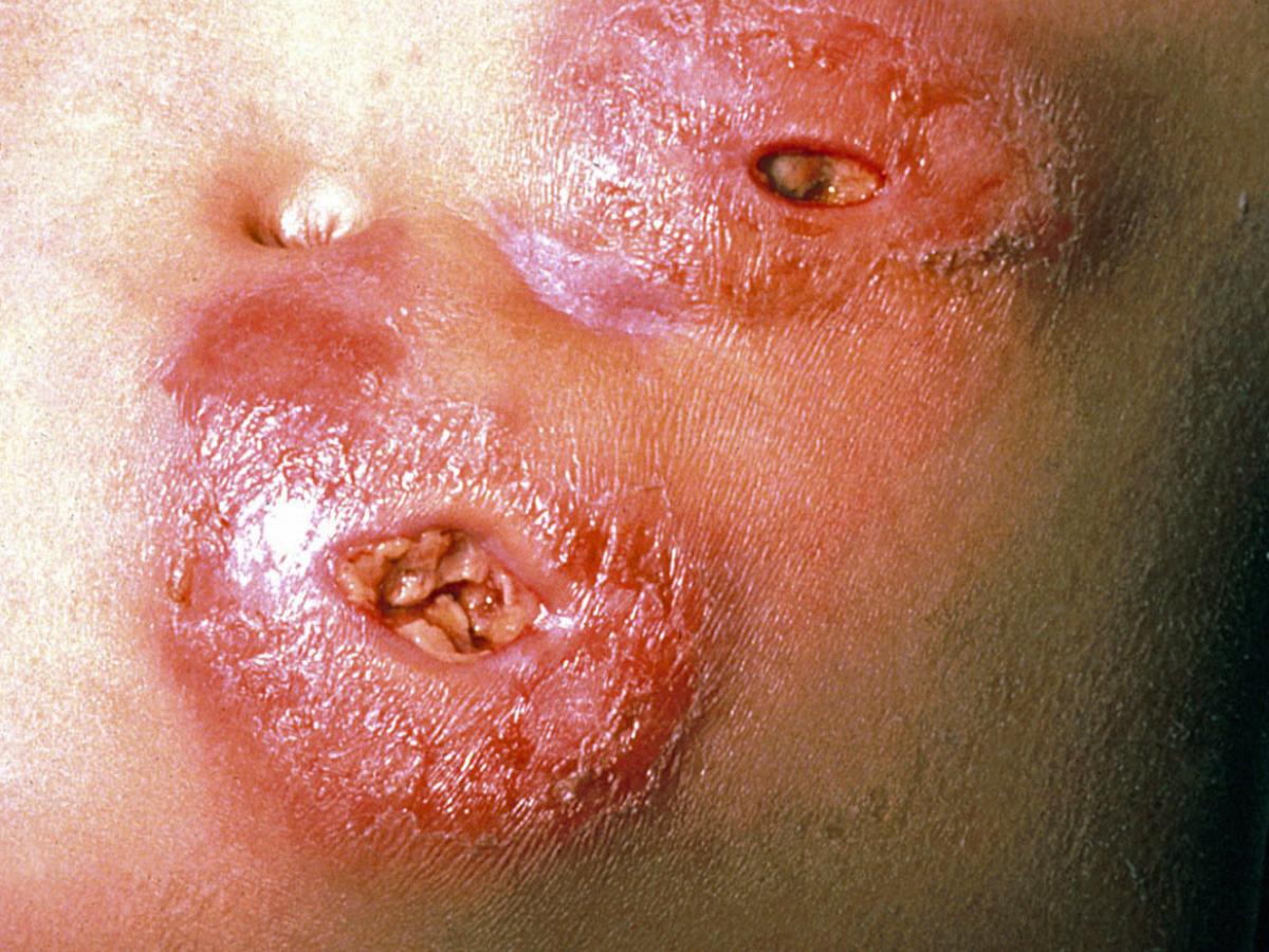 Zygomycosis caused by B. ranarum.