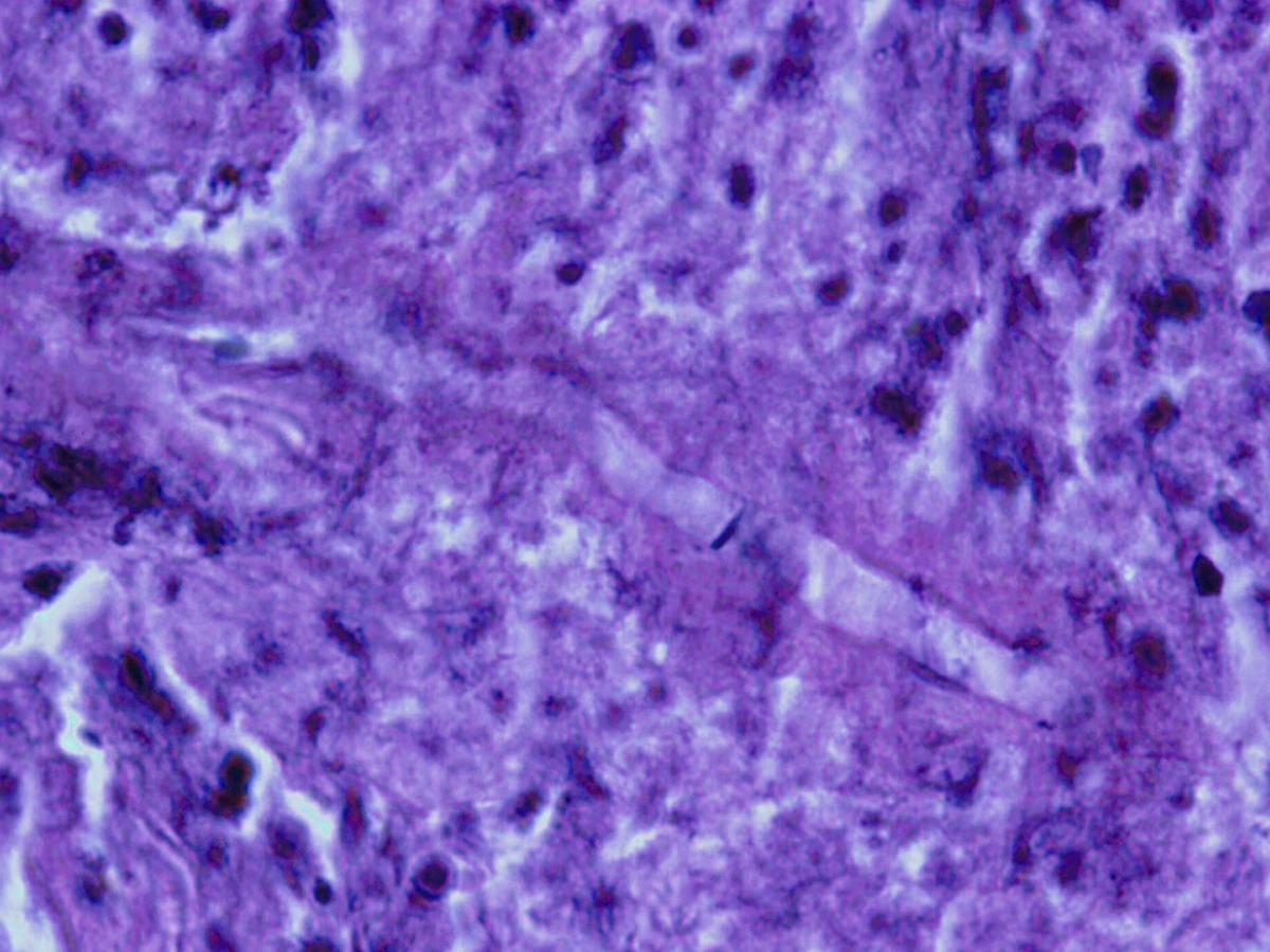 Zygomycosis caused by Basidiobolus.