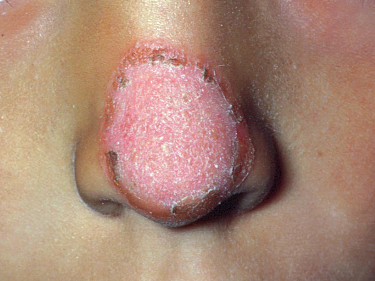 Nannizzia gypsea clinical