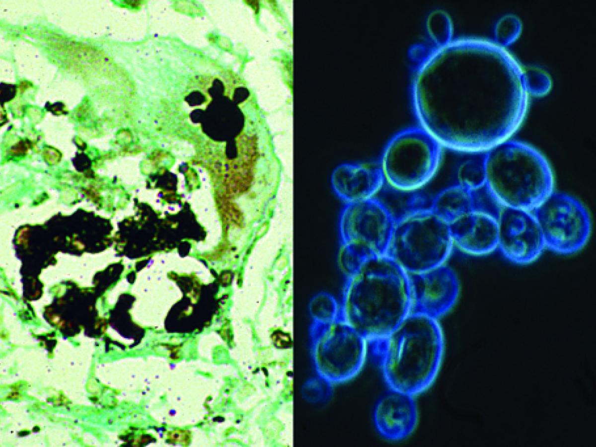 Paracoccidioidomycosis microscopy