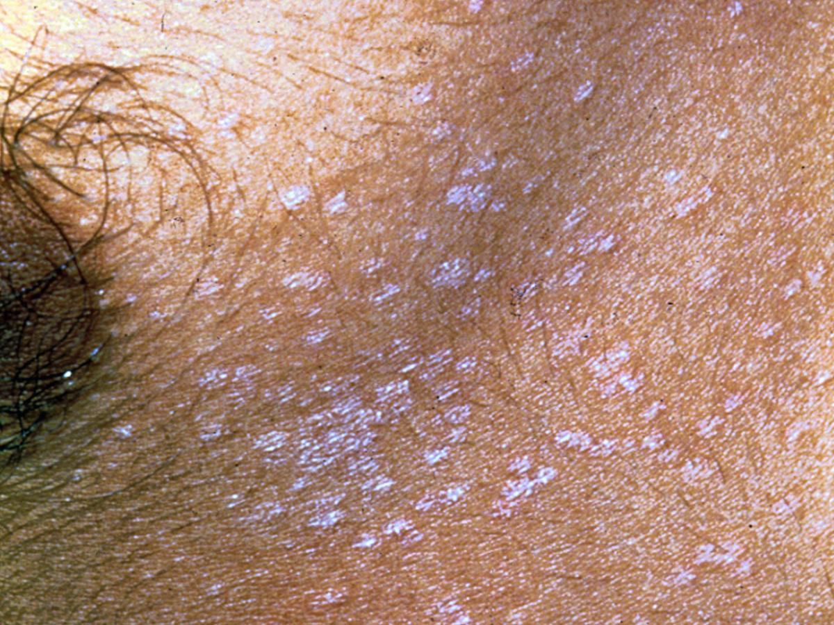 Pityriasis versicolor 3