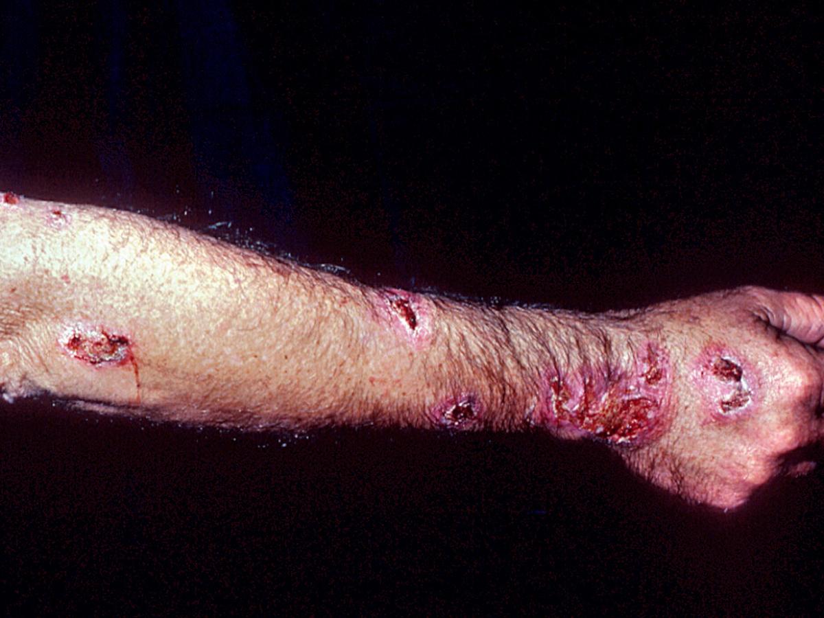 Lymphocutaneous sporotrichosis.