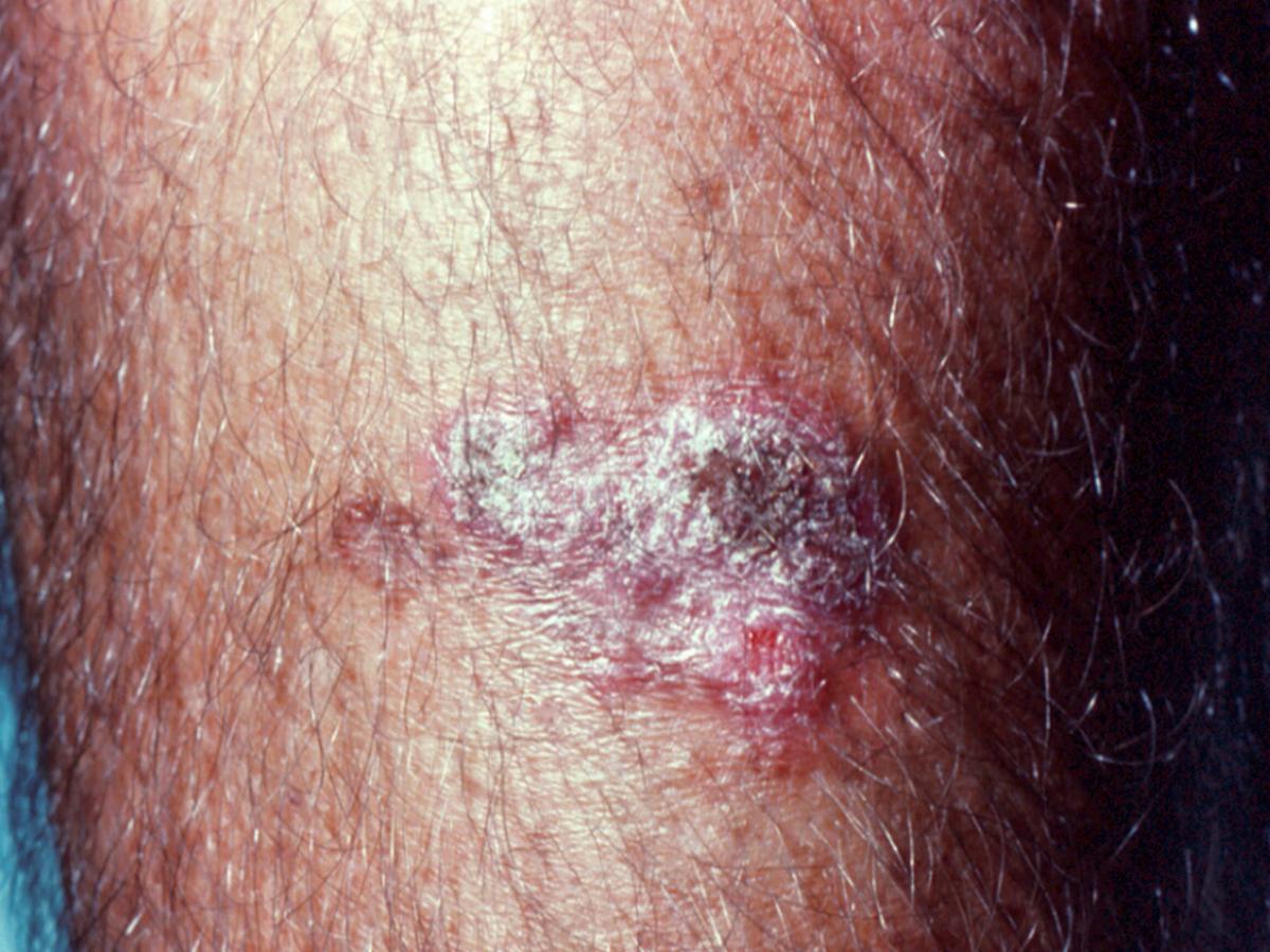 Fixed cutaneous sporotrichosis.