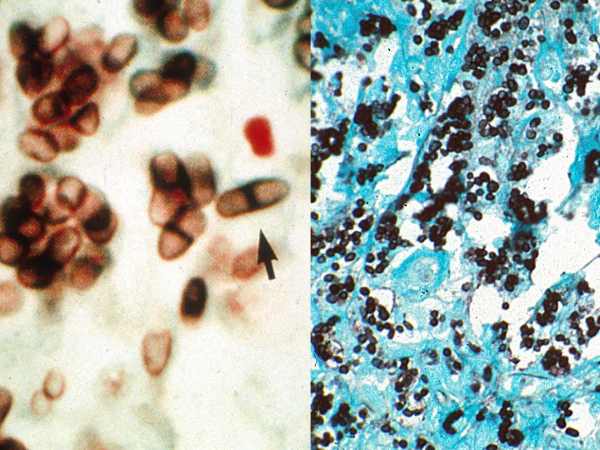 Histology of Talaromyces infection