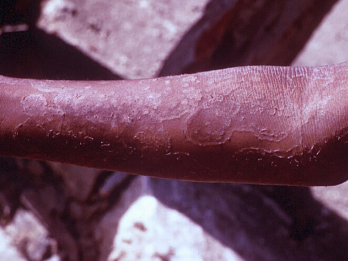 Trichophyton concentricum clinical