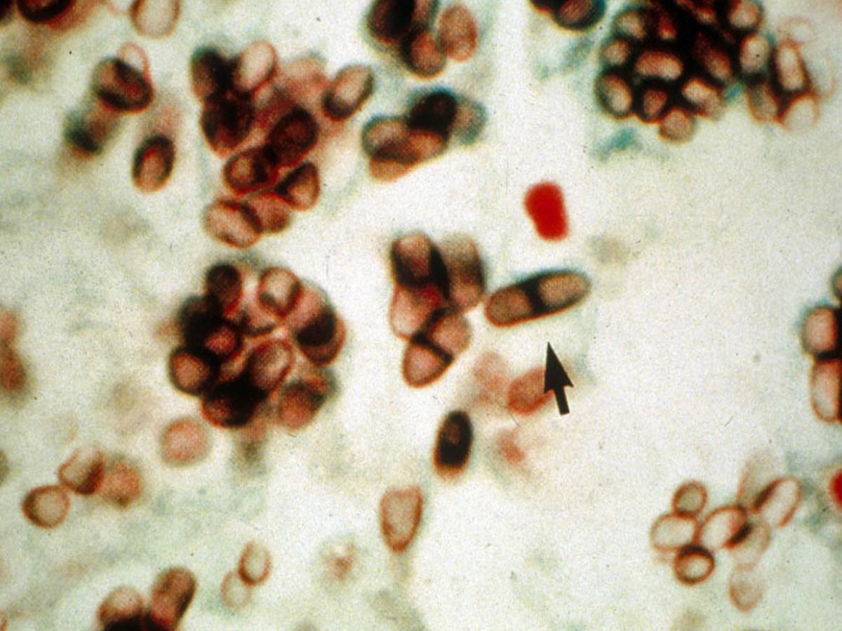Unknown 10 Direct microscopy (GMS staining) - 2