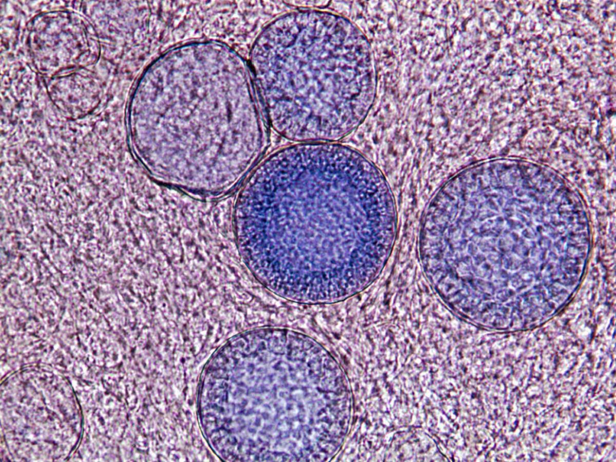 Unknown 34 direct microscopy (KOH stain)