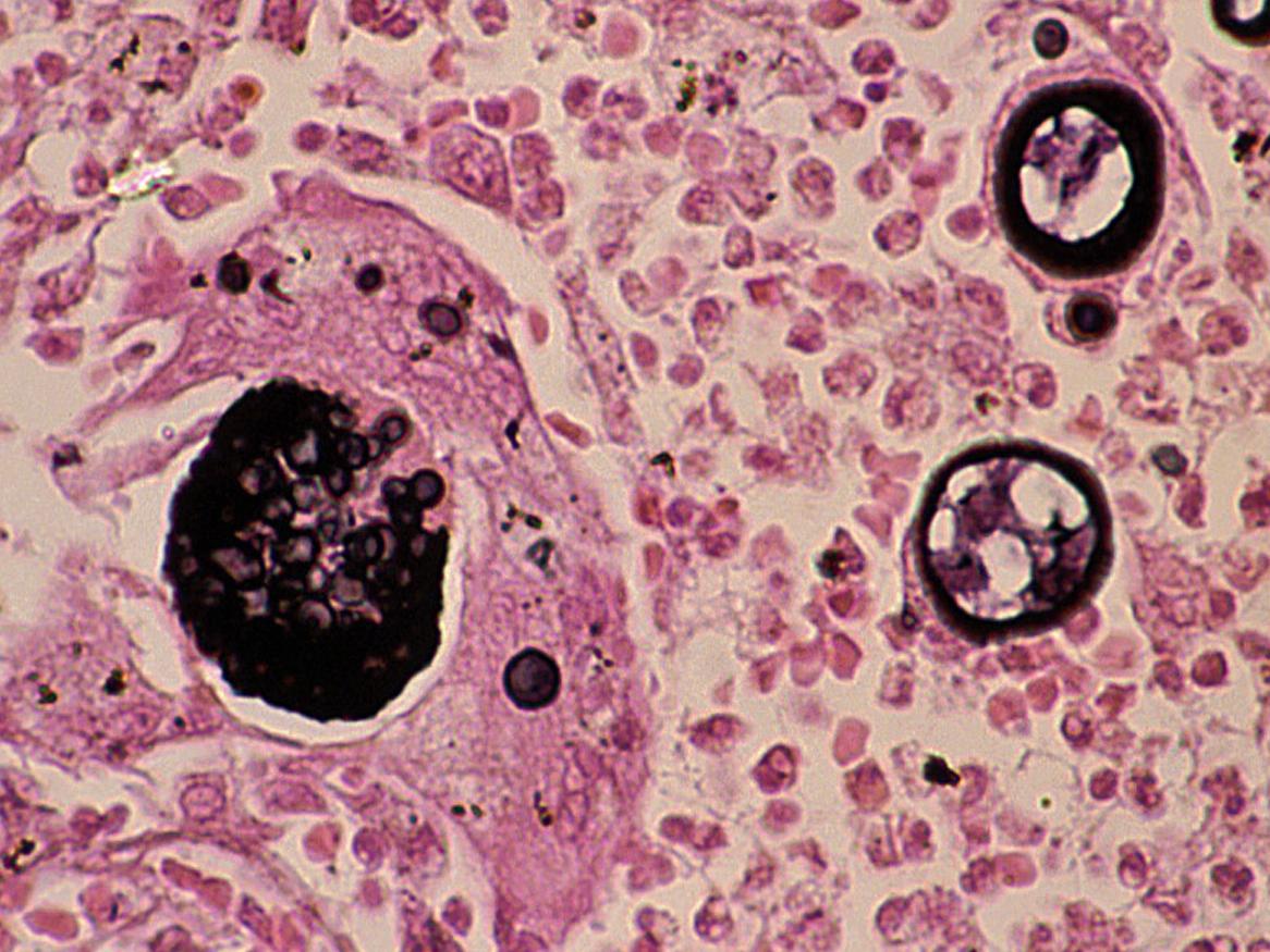 Dimorphic Fungal Infections